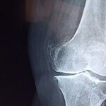 Buy, Hold or Sell Flexion Therapeutics?