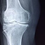 Bone Health Basics
