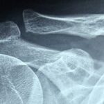 Why Chemo Kills Bone