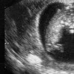 Abortion in Our Whacked-Out Era